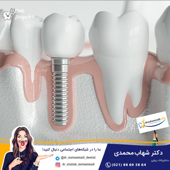 دردهای بعد از ایمپلنت دندان، چه عللی میتواند داشته باشند؟ - کلینیک دندانپزشکی دکتر شهاب محمدی